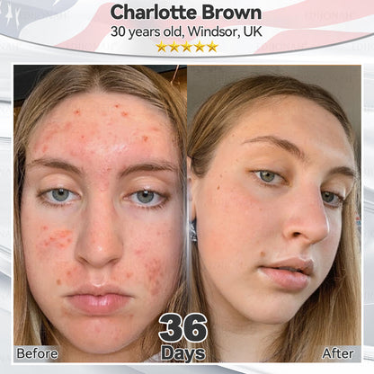 🎯🎯𝐸𝐷𝐼𝐽𝑂𝑁𝐴𝐻® 𝑆𝑡𝑒𝑚 𝐶𝑒𝑙𝑙 𝐸𝑥𝑜𝑠𝑜𝑚𝑒 𝑆𝑒𝑟𝑢𝑚  🐬🐬（ Anti-aging, reduces wrinkles, improves firmness, enhances radiance, provides deep hydration）